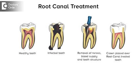 How To Tell If You Need A Root Canal After A Crown Does My Tooth Need | My XXX Hot Girl
