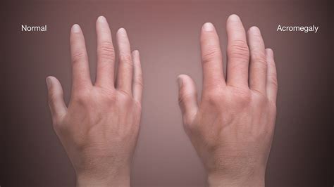 Acromegaly Shown in Human Hands Using Medical Animation Still Shot