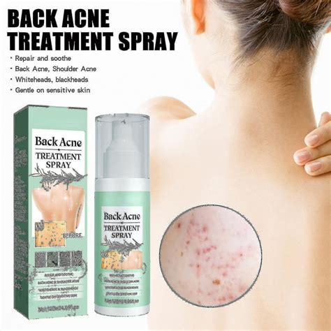 Back Acne Treatment, Back Acne Repair Spray, Body Acne Treatment Spray Hormonal Acne Treatment ...