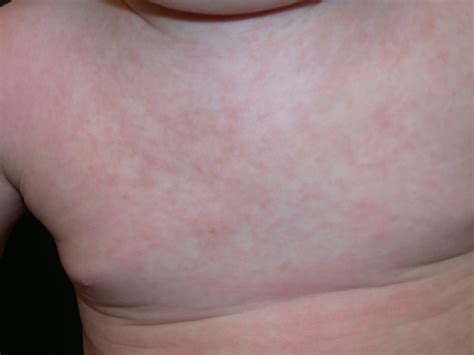 Post Viral Rash