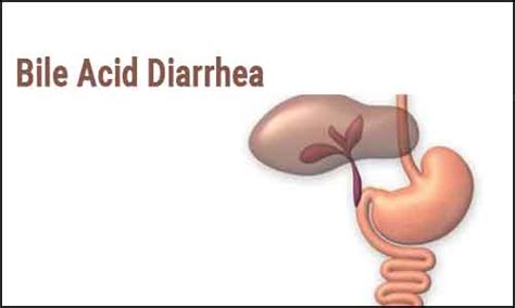 Management of Bile Acid Diarrhea: Canadian Association of ...