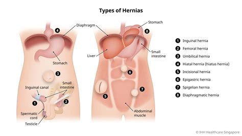 Femoral Hernia Men Or Women