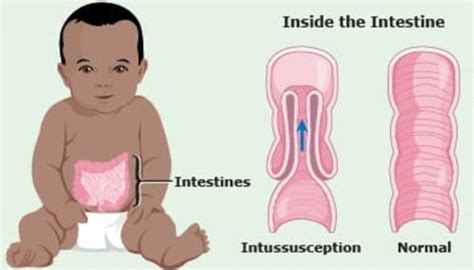 Image result for Intussusception Symptoms