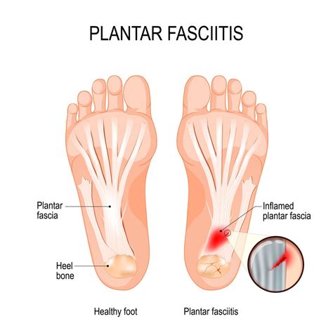 Learning About Plantar Fasciitis Quickly – Authentic Care