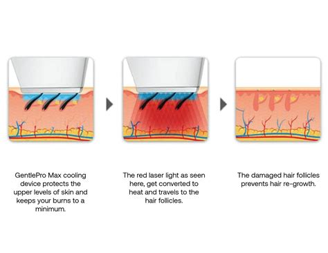 How to Treat Laser Hair Removal Burns - Crystal