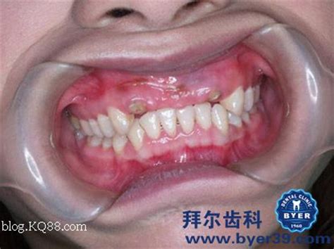 拜尔技术:上颌4个门牙的即刻种植-黎强的博客-KQ88口腔博客