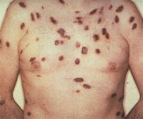 herpes 8 kaposi sarcoma
