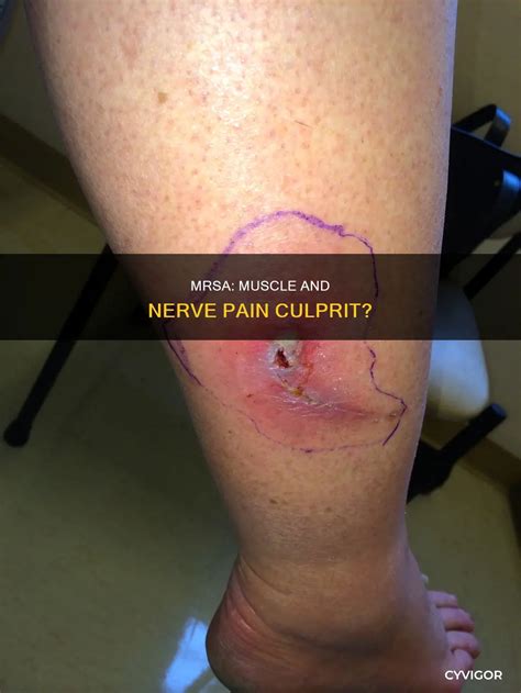 Mrsa: Muscle And Nerve Pain Culprit? | CyVigor