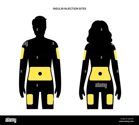 Insulin injection sites, illustration Stock Photo - Alamy