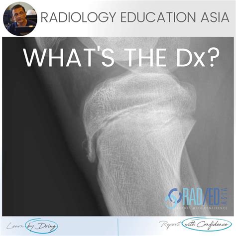 OSGOOD SCHLATTER RADIOLOGY X-RAY (VIDEO) - Radiology Education Asia