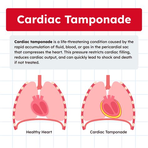 Cardiac Tamponade: Overview and Practice Questions (2026)