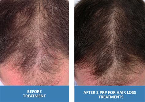 PRP For Hair Loss - Platelet Rich Plasma in Springfield Missouri