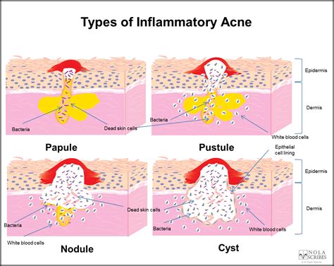 Epidermoid Cyst Icd 10