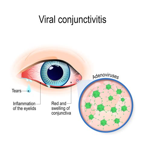 Bacterial Conjunctivitis