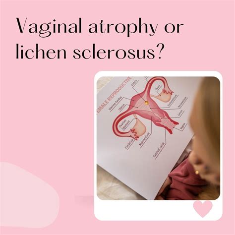 Lichen Sclerosus Vaginal And Cancer – OIJXJA