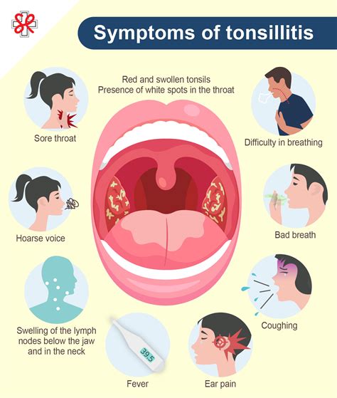 What is Tonsillitis? Learn about its symptoms, causes, and treatments ...