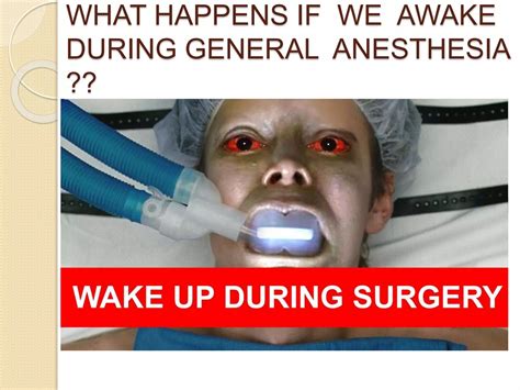 Anesthesia Awareness 的图像结果