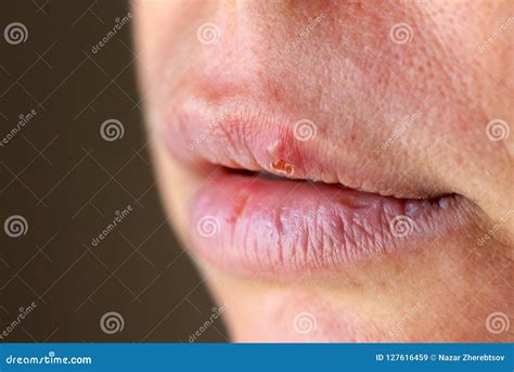 Herpes on the Lip Close Up Macro Stock Image - Image of person ...