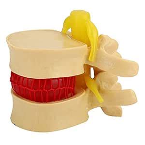 Human Lumbar Vertebrae Degenerative, Professional Lumbar Spine Model, 1 ...