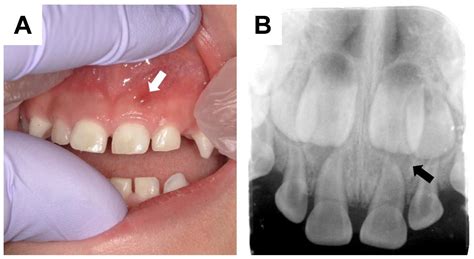Image result for Abscessed Tooth Explosion