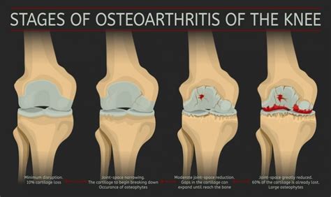 Osteoarthritis Knee Pain - Carolinas Pain Center - Charlotte - Huntersville