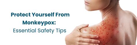 Protect Yourself from Monkeypox: Follow These Key Guidelines