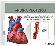 angina pectoris 的图像结果