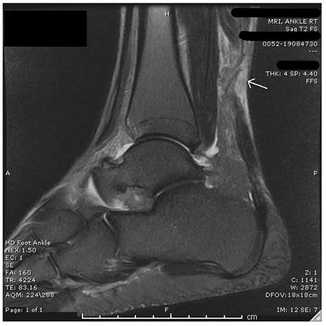 Bilateral Achilles Tendon Rupture: A Case Report and Review of the ...