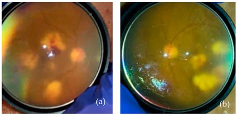 Endogenous Fusarium Endophthalmitis after Bone Marrow Transplant: A ...