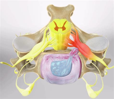 Image result for Selective Nerve Root Block Contrast Spread Pattern