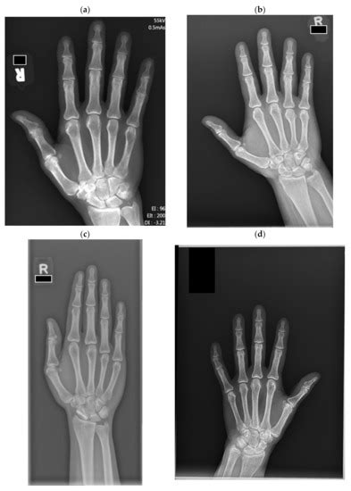 Quality of Hand Radiograph Collimation Determined by Artificial ...