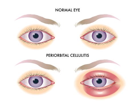 Periorbital Cellulitis (Symptoms, Causes & Treatment)