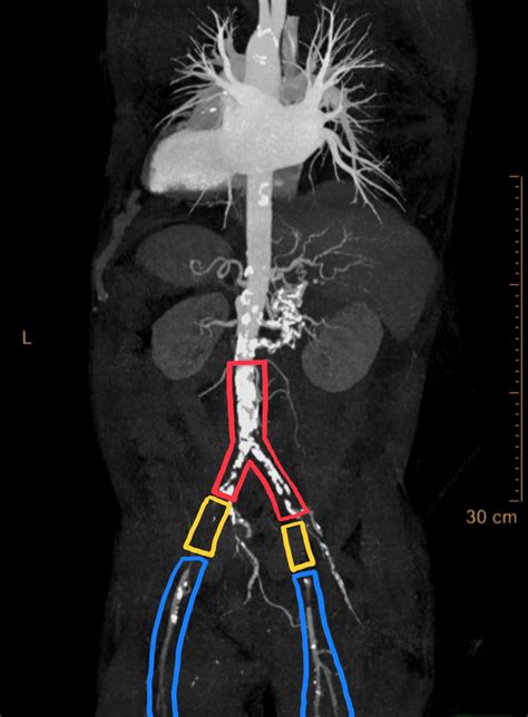 Initial Management and Recognition of Aortoiliac Occlusive Disease, A Case Report - JETem