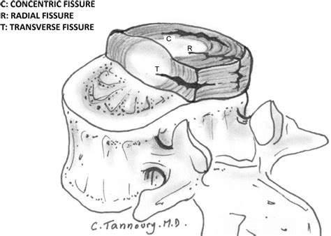 Transverse Fissure