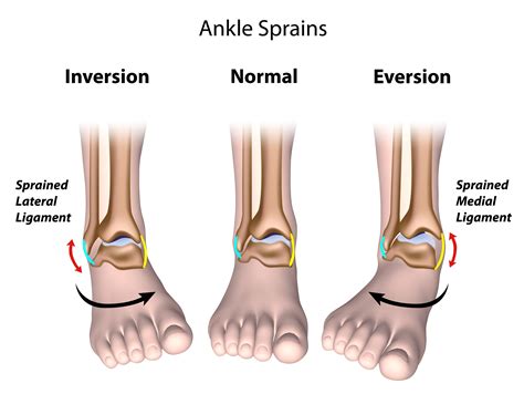 Chronic Lateral Ankle Pain - Palmerton, PA: Pancholi Foot and Ankle