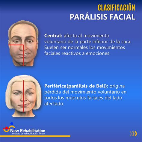 Parálisis facial, sus diferentes tipos y cómo recuperarte | NewRehabilitation