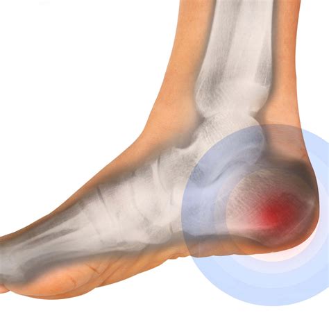 How To Get Rid Of Heel Pain After Running | RunnerClick