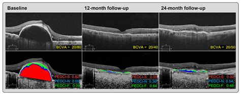 Prognostic Optical Coherence Tomography Biomarkers in Neovascular Age-Related Macular Degeneration