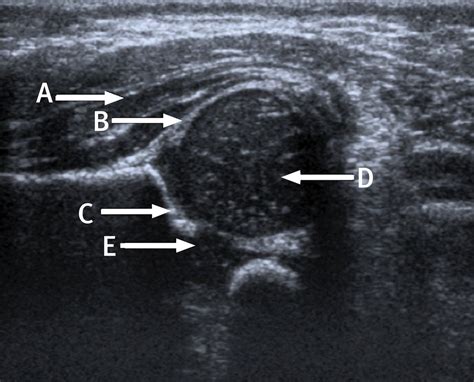 Coronal ultrasound anatomy of a normal hip in a newborn baby | The BMJ