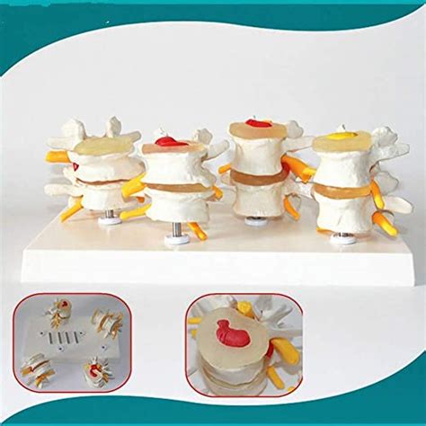 Buy Anatomy Model, Assembly Assembly Model 4-Stage Human Lumbar Lesion ...