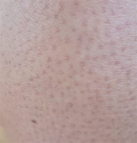Keratosis Pilaris: What is it, and Can it be Treated? - Dr Nathan Holt