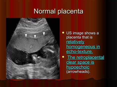 Placenta ultrasound | PPT