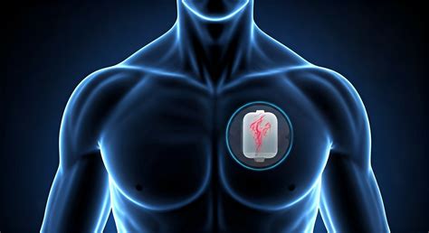 Defibrillator Types 的图像结果