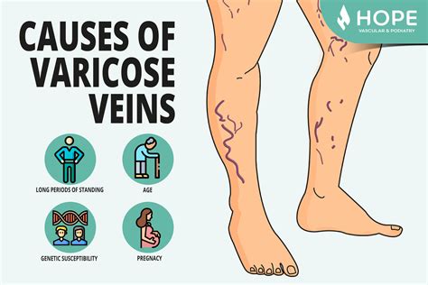 Understanding the Main Causes of Varicose Veins - Houston Vascular & Podiatry Surgeons