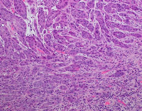 Moderately differentiated squamous cell carcinoma of the floor of oral ...