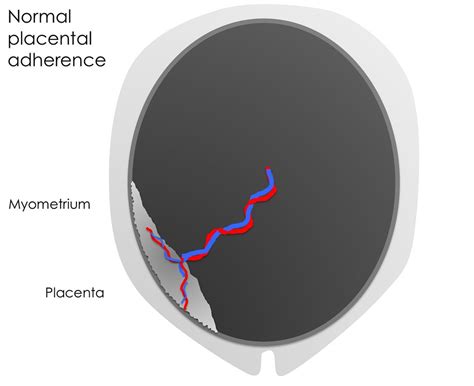Placenta Accreta - Causes, Symptoms, Diagnosis, Risk Factors, Treatment