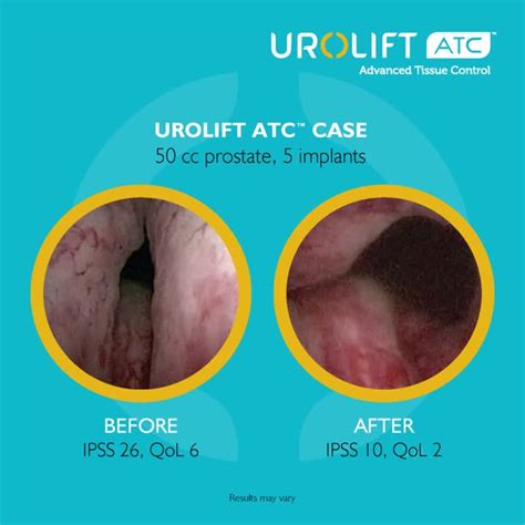 Image result for Problems After UroLift