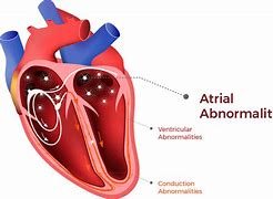 Image result for Atrial