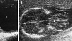 Image result for cenencephalocele