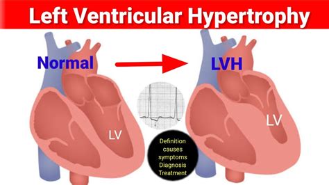 LVH/ Left ventricle Hypertrophy/ causes/Diagnosis/treatment/ How to regress LVH/ LVH क्या होता है
